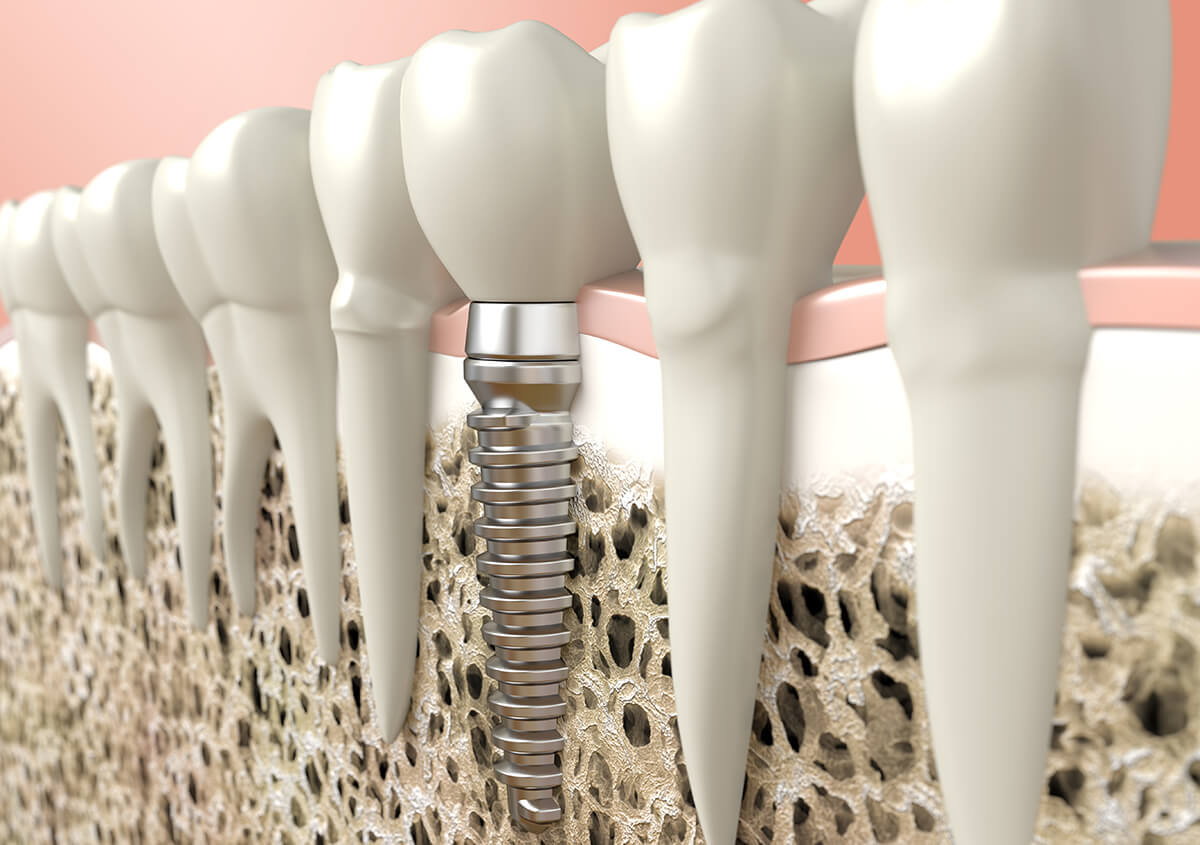Tooth Implant Process at Starcare Dental in Glen Mills PA Area