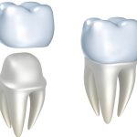 Crowns for Teeth in West Chester Area
