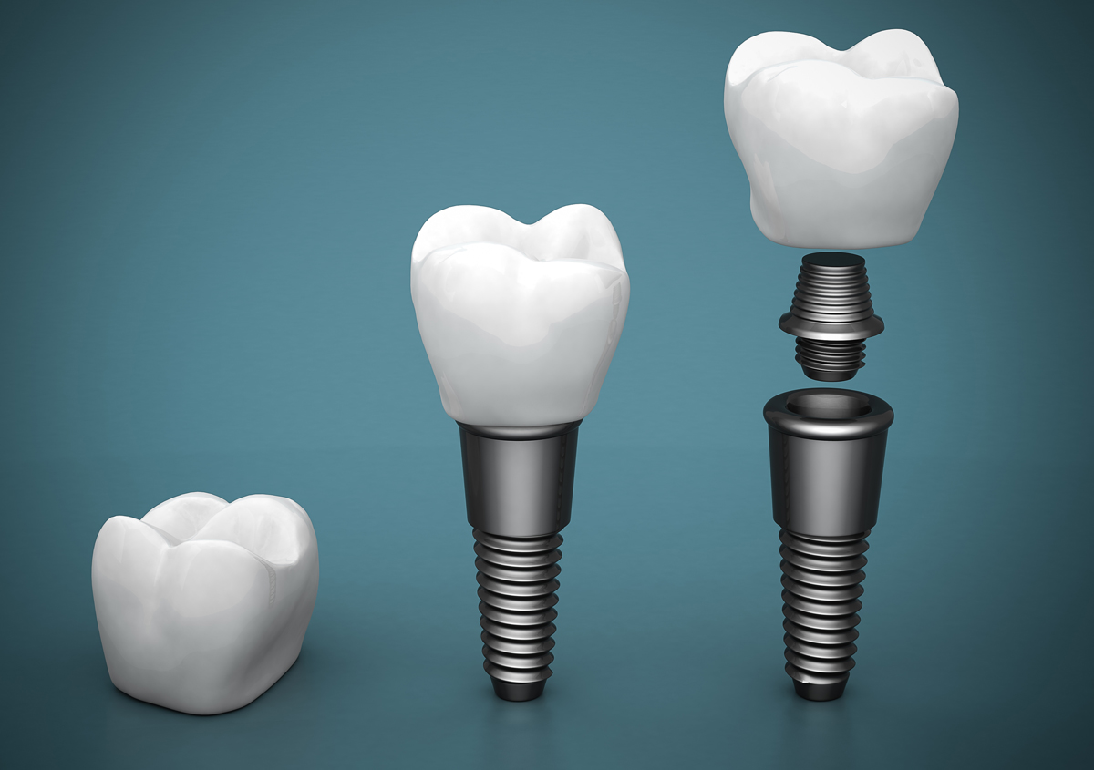 Trusted And Reliable Implant Dentist Near Me in West Chester Area
