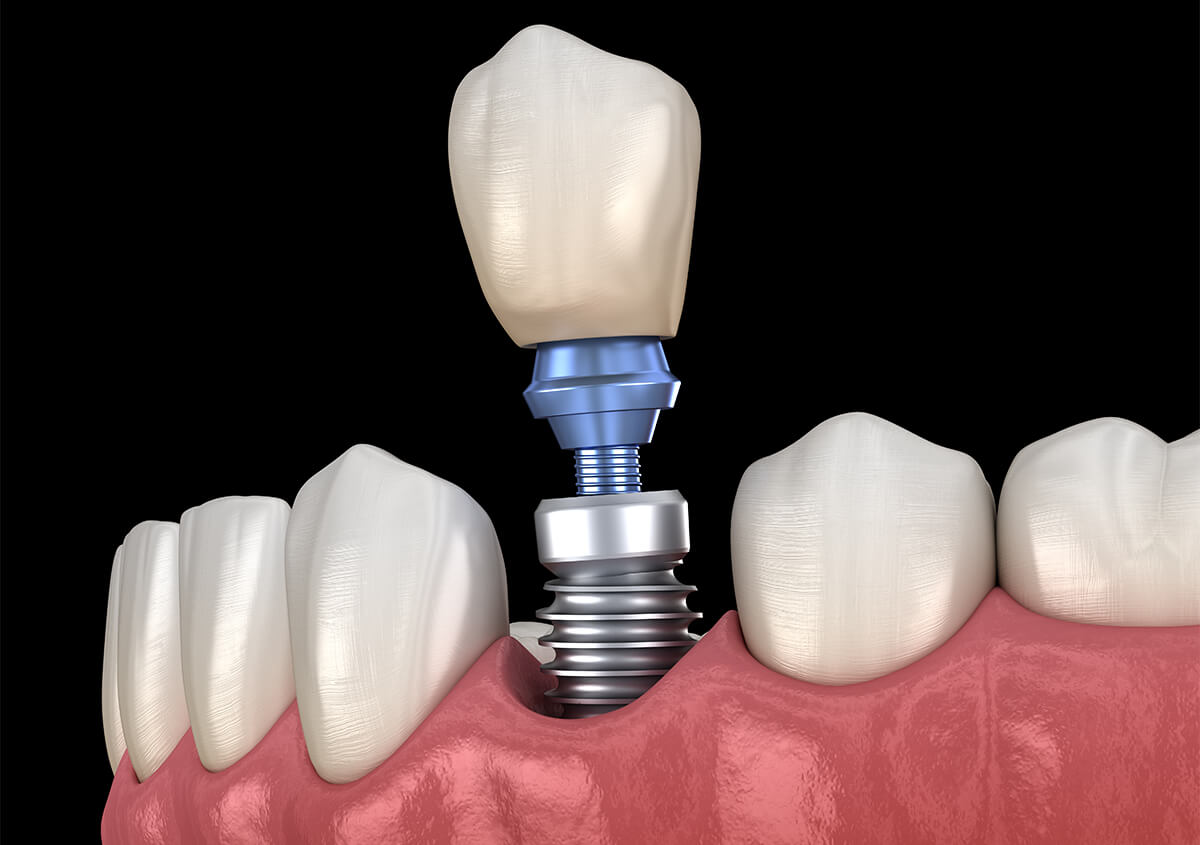 Teeth Implants Dentist in Glen Mills Area
