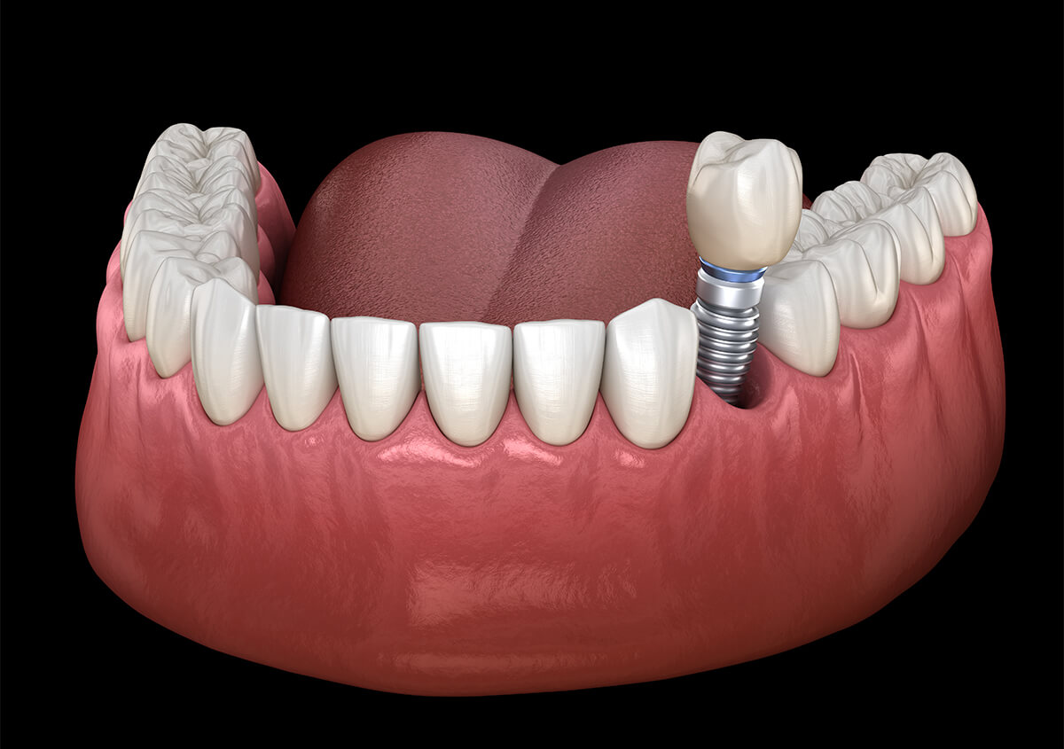 Implant Dentist in Pennsylvania PA Area